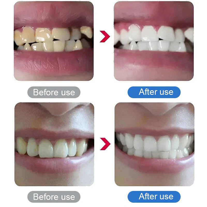 💎UP TO 50% OFF!!🦷✨Electric Ultrasonic Dental Scaler for Tartar and Plaque Removal - Image 6